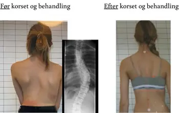 Skoliose / scoliose behandling ved fysioterapeut i FysioHuset Randers